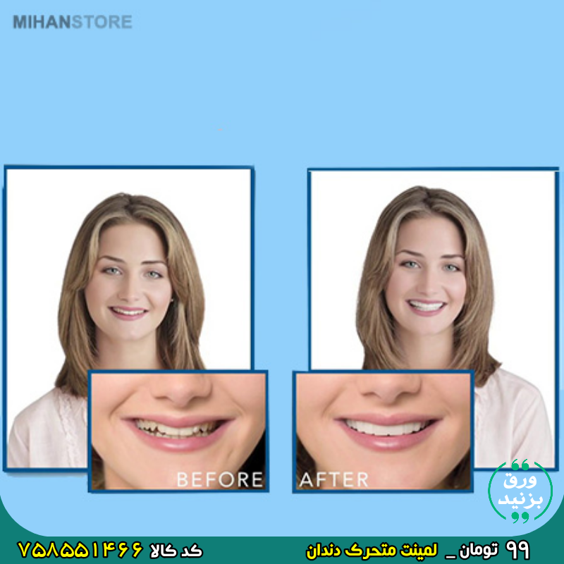 758551466 لمینت متحرک دندان برای خرید اینجا کلیک کنید 🎀 برای دیدن عکسهای بیشتر ورق بزنید 🎀
🔸 لمينت دندان مدل Big smile
🔸 دارای تاییدیه بهداشتی
🔸 طراحی بسیار دقیق و نازک بدون ایجاد مشکل در استفاده
🔸 مناسب پوشاندان فاصله های بین دندانی
🔸 تولید شده از جنس مواد پزشکی درجه یک
🔸 زیبا سازی سریع و راحت دندانها
🔸 لمینت دندان دوفک اسنپ Big smile 🔴 قیمت 99 هزار تومان
کد ۷۵۸۵۵۱۴۶۶ _ 758551466
کد ۳۲۳۴۷۸۲ _ 3234782
کد ۱۰۹۹۳۵۱ _ 1099351
